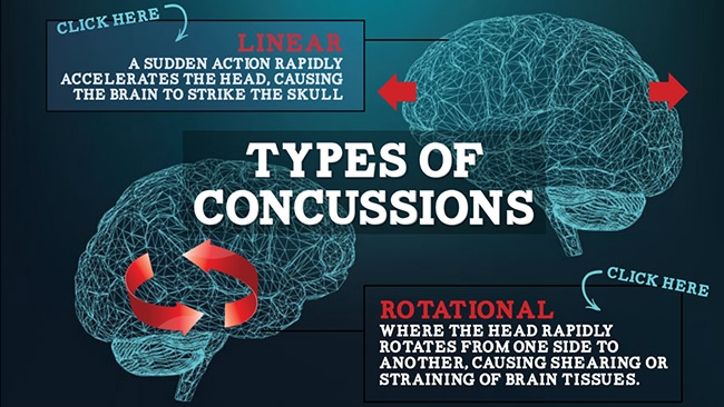 Concussion Awareness Preview 1